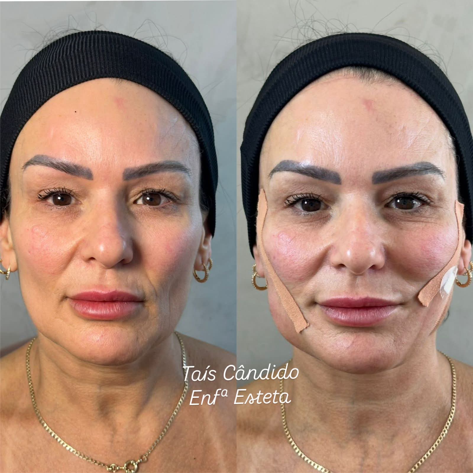 Resultado Harmonização Facial – antes e depois