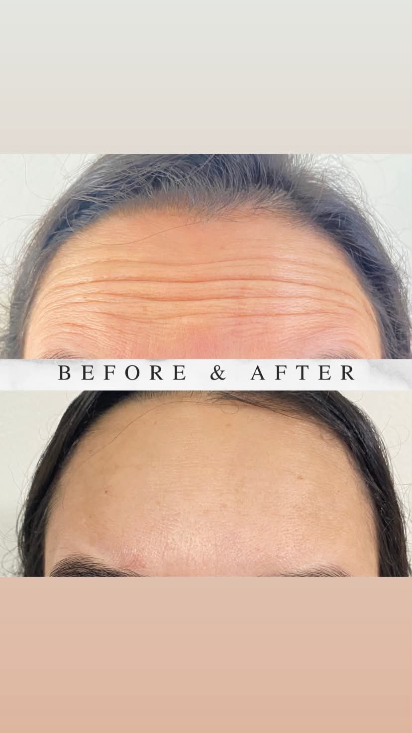 Resultado Toxina Botulínica – antes e depois