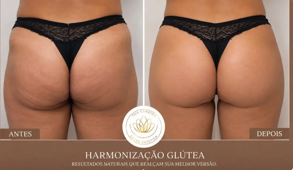 Resultado Harmonização Glútea – antes e depois