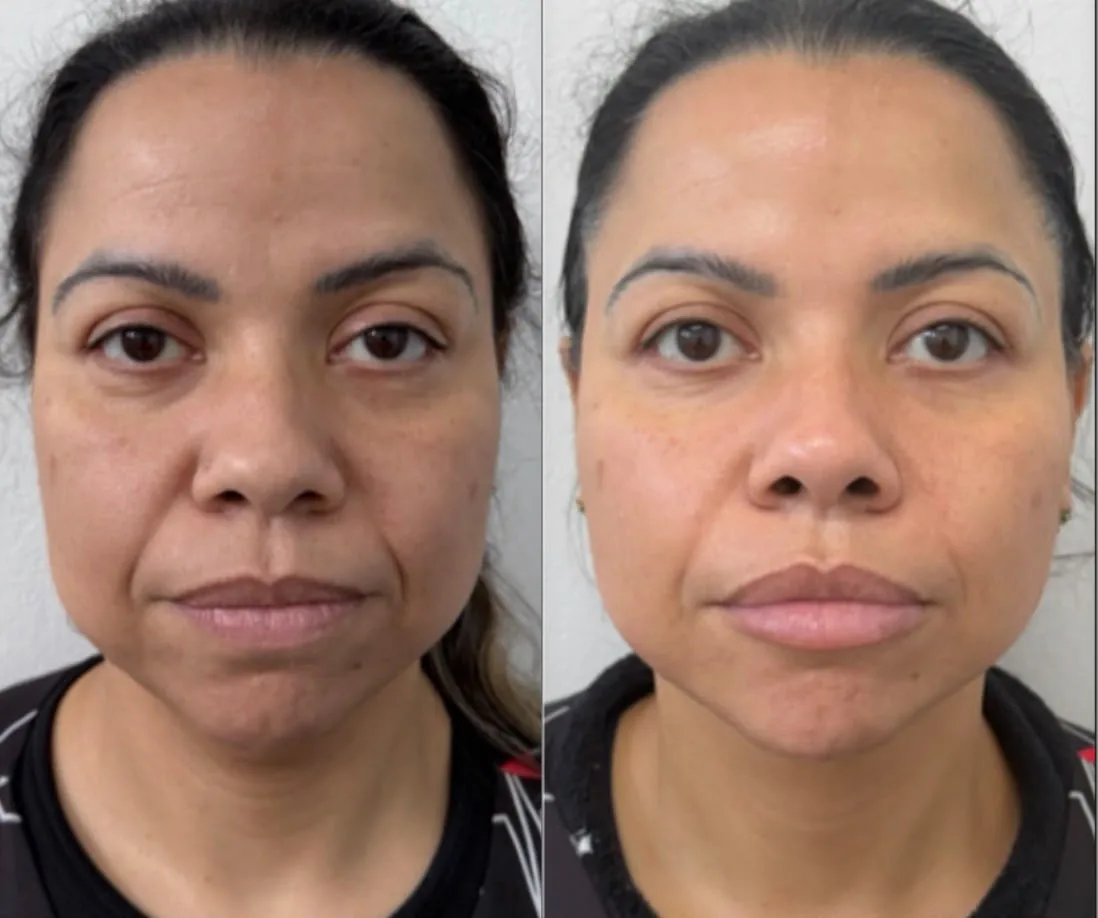 Resultado Harmonização Facial – antes e depois