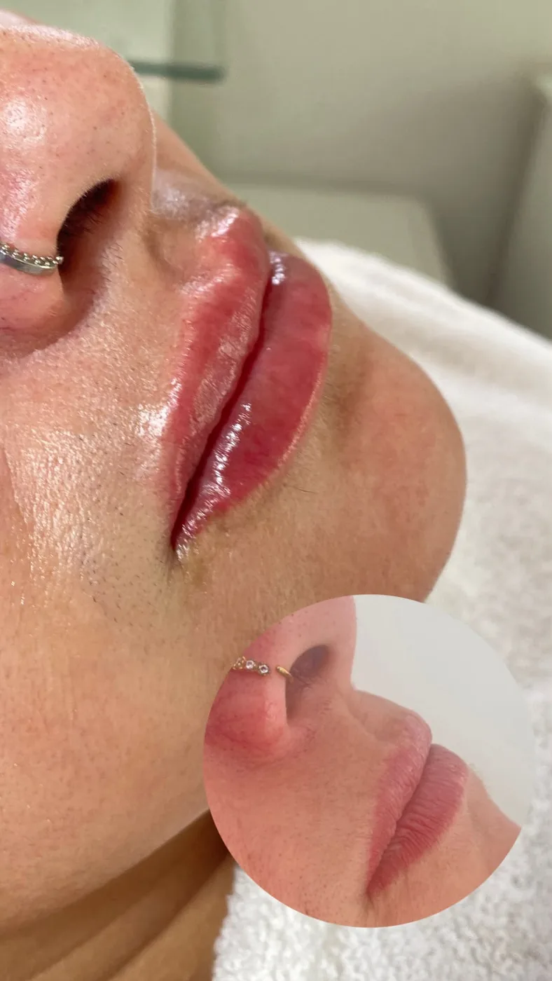 Resultado Preenchimento Labial – antes e depois