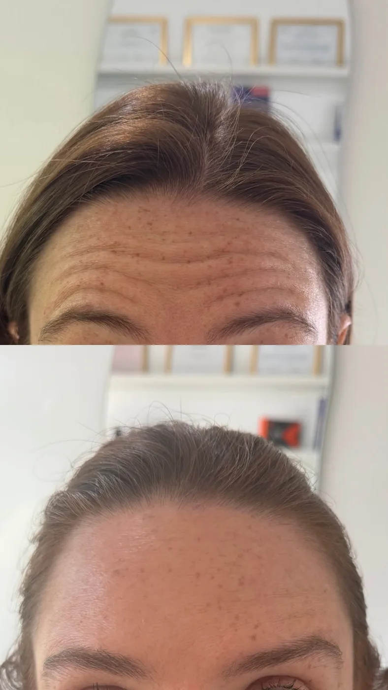 Resultado Toxina Botulínica – antes e depois
