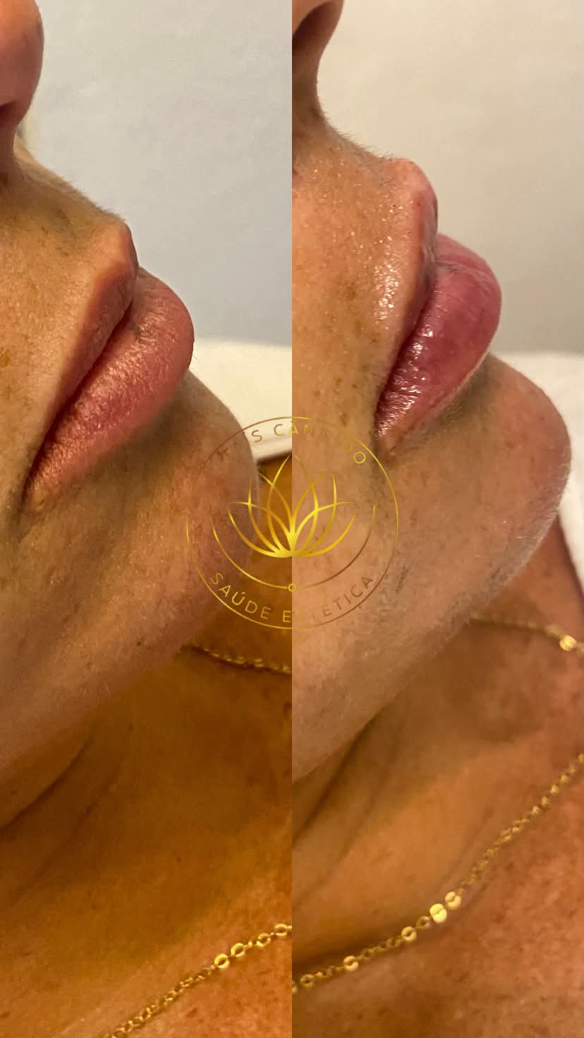 Resultado Preenchimento Labial – antes e depois